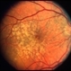 Dry Age-Related Macular Degeneration Dry Age-Related Macular Degeneration