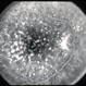 Dry Age-Related Macular Degeneration Dry Age-Related Macular Degeneration