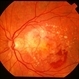 Age-Related Macular Degeneration Age-Related Macular Degeneration