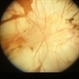 Congenital Monocular Choroidal Atrophy