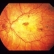 Pattern Dystrophy
