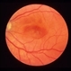 AMN Acute Macular Neuroretinopathy