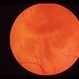 AMN Acute Macular Neuroretinopathy
