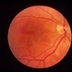 AMN Acute Macular Neuroretinopathy