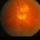 Perpapillary Atrophy Perpapillary Atrophy
