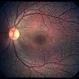 Fundus Albipunctatus Fundus Albipunctatus