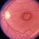 Macular Dystrophy With Drusenoid Deposit Macular Dystrophy With Drusenoid Deposit