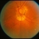 Peripapillary Atrophy Peripapillary Atrophy