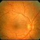 Fundus Albipunctatus Fundus Albipunctatus