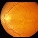 Stargardt's Dystrophy