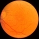 Dry Macular Degeneration Dry Macular Degeneration