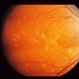 Stargardt's Dystrophy
