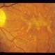 Stargardt's Dystrophy