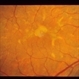 Stargardt's Dystrophy