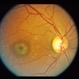 Stargardt's Disease