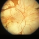 Congenital Monocular Choroidal Atrophy