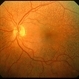 Fundus Albipunctatus Fundus Albipunctatus