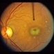 Stargardt's Disease