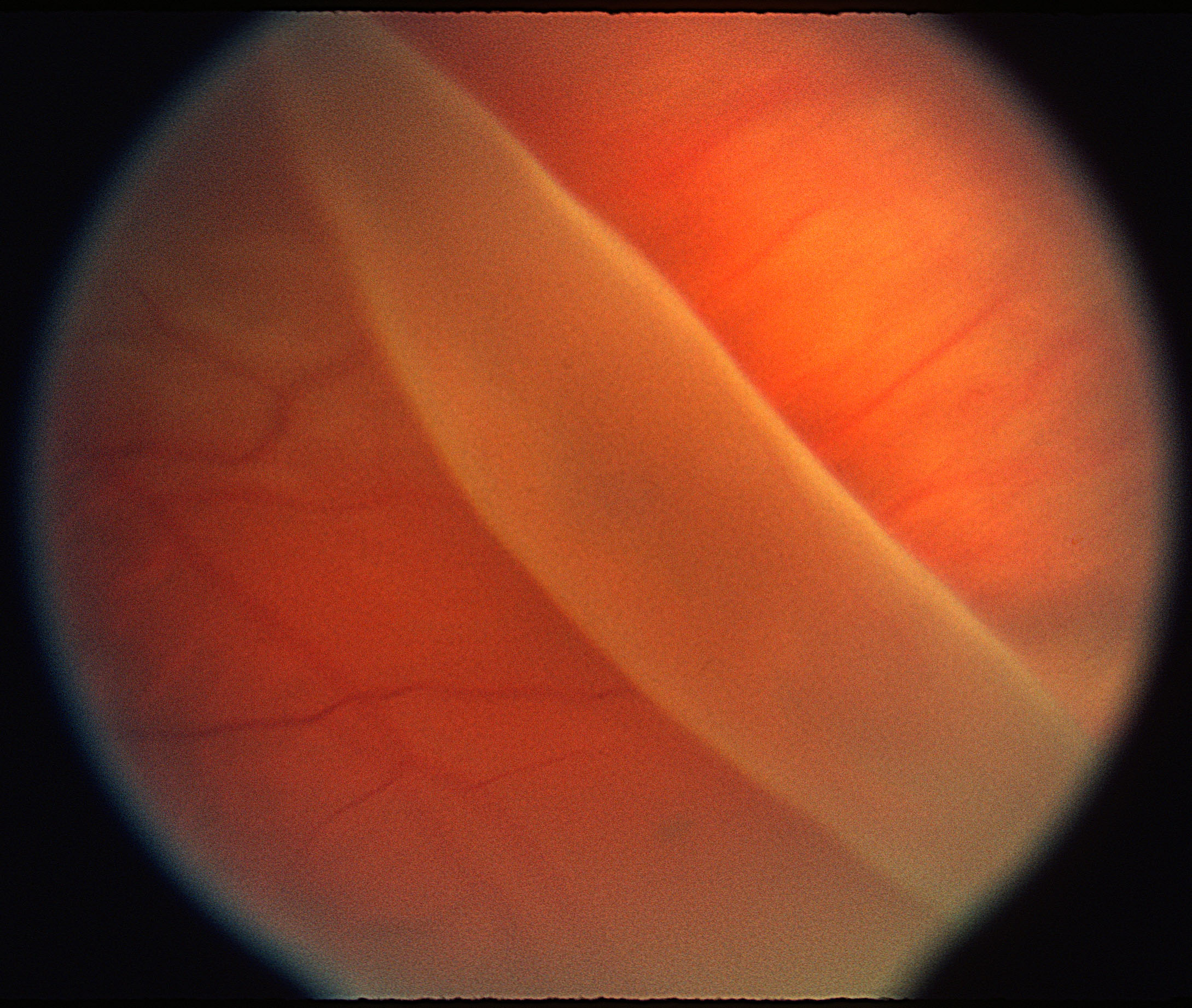 retina tear retina tear