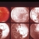 Inflammation Inflammation