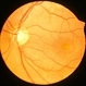 Multiple Vitellitorn Retinal 2