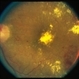 Hypertensive Retinopathy Hypertensive Retinopathy