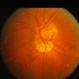 Peripapillary Atrophy Peripapillary Atrophy
