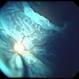 Giant Retinal Tear Giant Retinal Tear