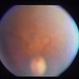 Congenital Toxoplasmosis