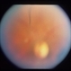 Congenital Toxoplasmosis