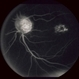 Stargardt's Dystrophy