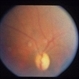 Congenital Toxoplasmosis