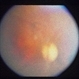 Congenital Toxoplasmosis