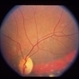 Congenital Toxoplasmosis
