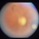 Congenital Toxoplasmosis