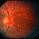 Hodgkin's Disease Stage IV