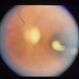 Congenital Toxoplasmosis