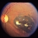 Congenital Toxoplasmosis