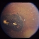Congenital Toxoplasmosis