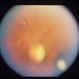 Congenital Toxoplasmosis