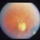 Congenital Toxoplasmosis