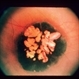 Congenital RPE Hypertrophy