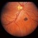 Congenital RPE Hypertrophy