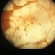 Congenital Monocular Choroidal Atrophy
