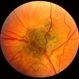Combined  Hamartoma of Retina and RPE Combined  Hamartoma of Retina and RPE