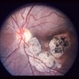 RPE Hypertrophy In The Posterior  Pole