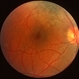 Combined  Hamartoma of Retina and RPE Combined  Hamartoma of Retina and RPE