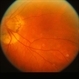 Peripapillary Atrophy Peripapillary Atrophy
