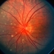 Hodgkin's Disease State IV Hodgkin's Disease State IV