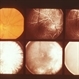 Inflammation Inflammation